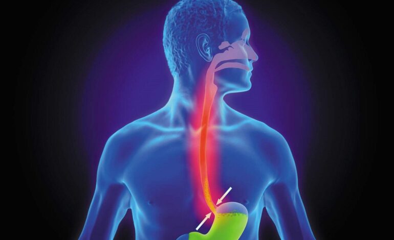 Acid Reflux Treatment in Dubai: Causes and Care Plans