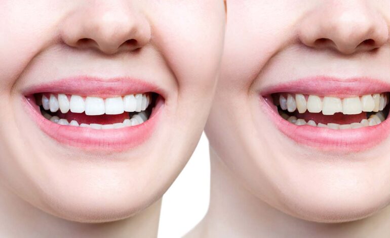 Dental Bonding in Cypress