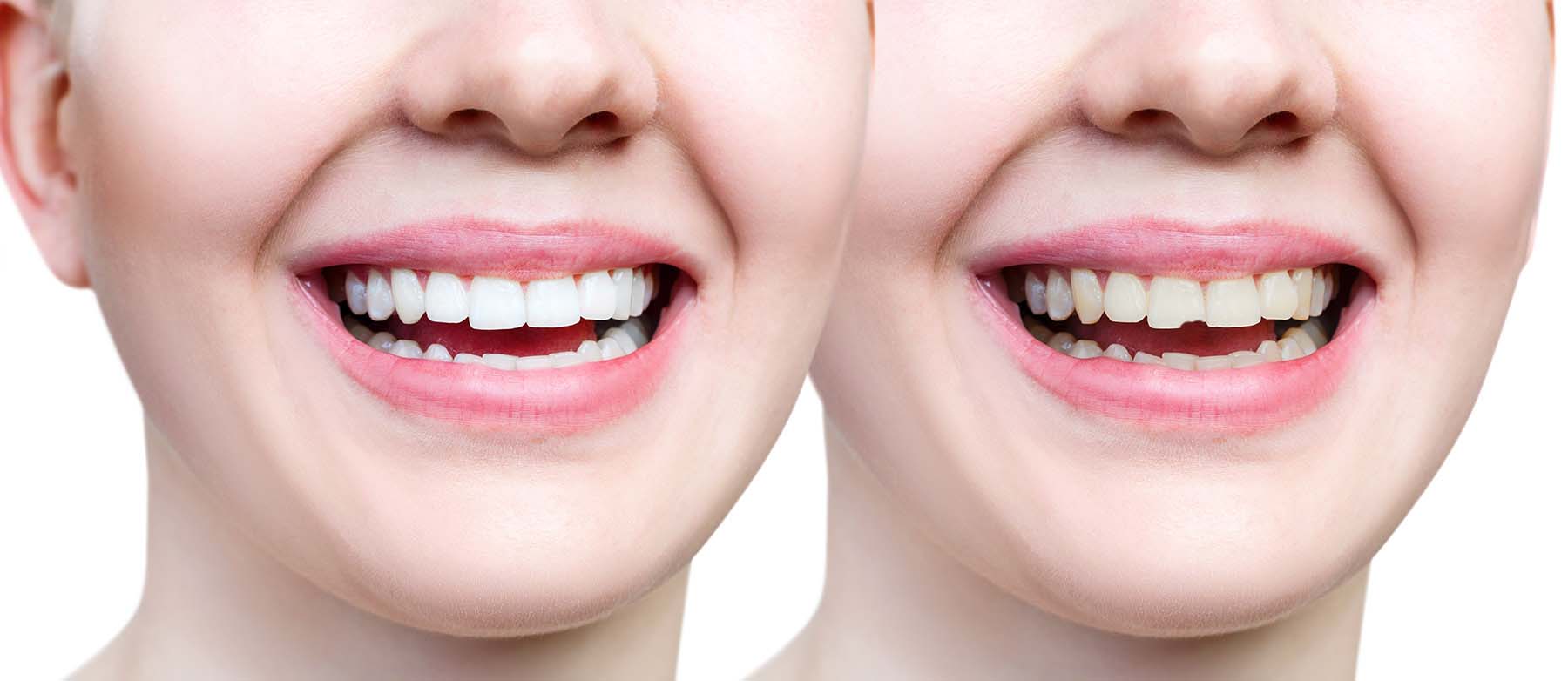Chipped Tooth? Dental Bonding Might Be Your Best Fix