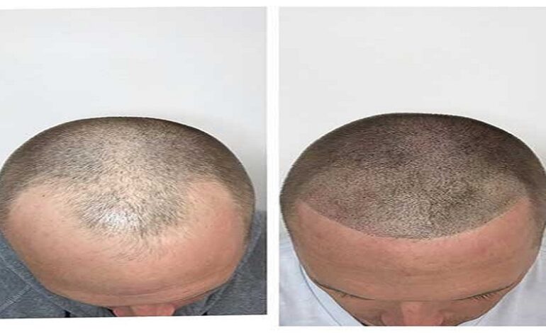 Male Pattern Baldness treatment