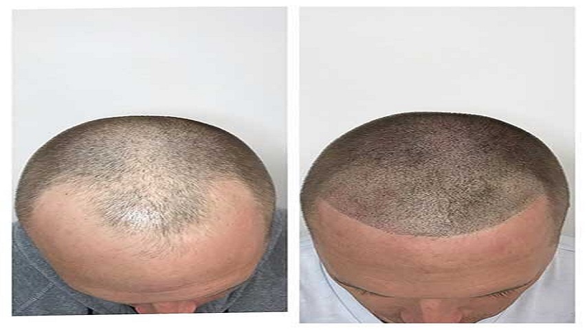 Male Pattern Baldness Explained: Why It Happens and How to Manage It