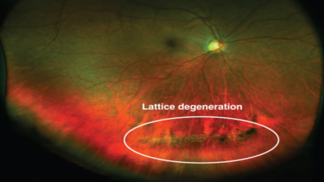What Lattice Degeneration Laser Treatment Can Do for You
