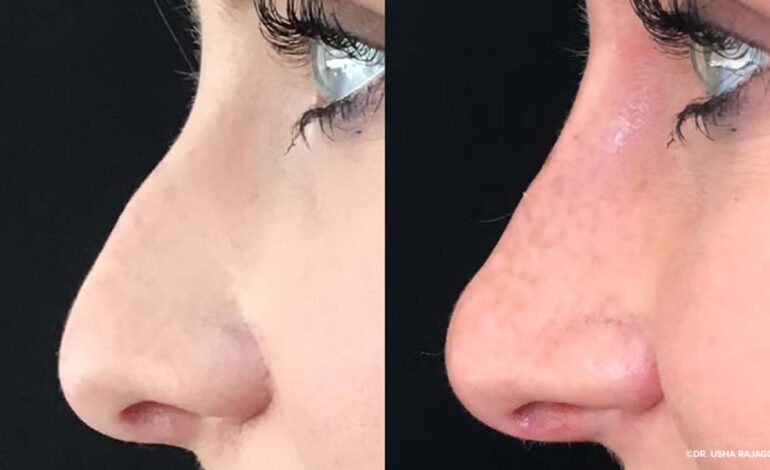Best Rhinoplasty in Dubai: Procedure and Recovery Guide
