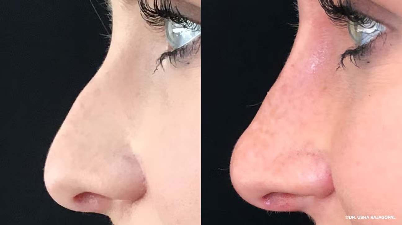 Best Rhinoplasty in Dubai: Procedure and Recovery Guide