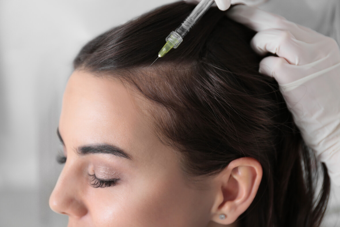 Female Hair Transplant in UK: A Modern Solution for Hair Loss and Hair Restoration