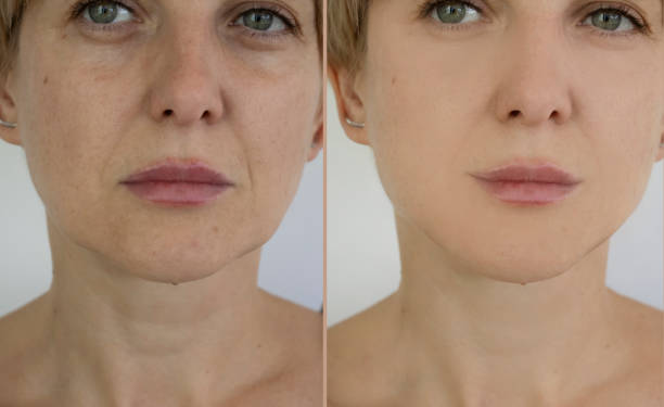 Double Chin Removal in Abu Dhabi