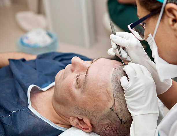 زراعة الشعر في دبي لاستعادة خط الشعر الطبيعي مع تقدم العمر