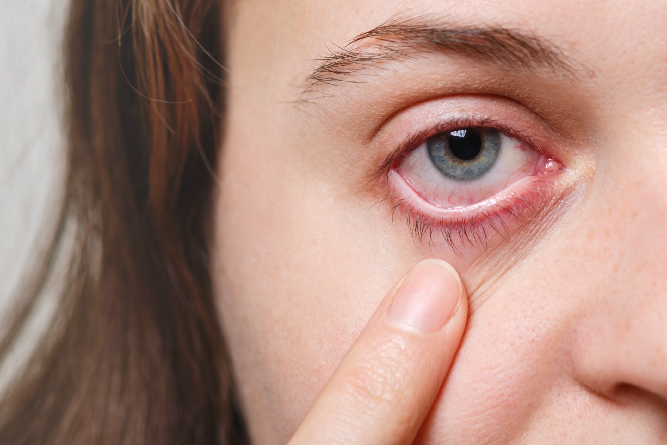 When Pink Eye Symptoms Need Urgent Care in Chicago
