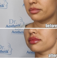 Dezente Lippenvergrößerung