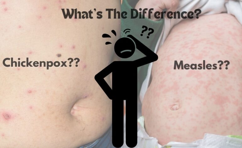 Difference Between Measles and Chickenpox: Symptoms, and treatment