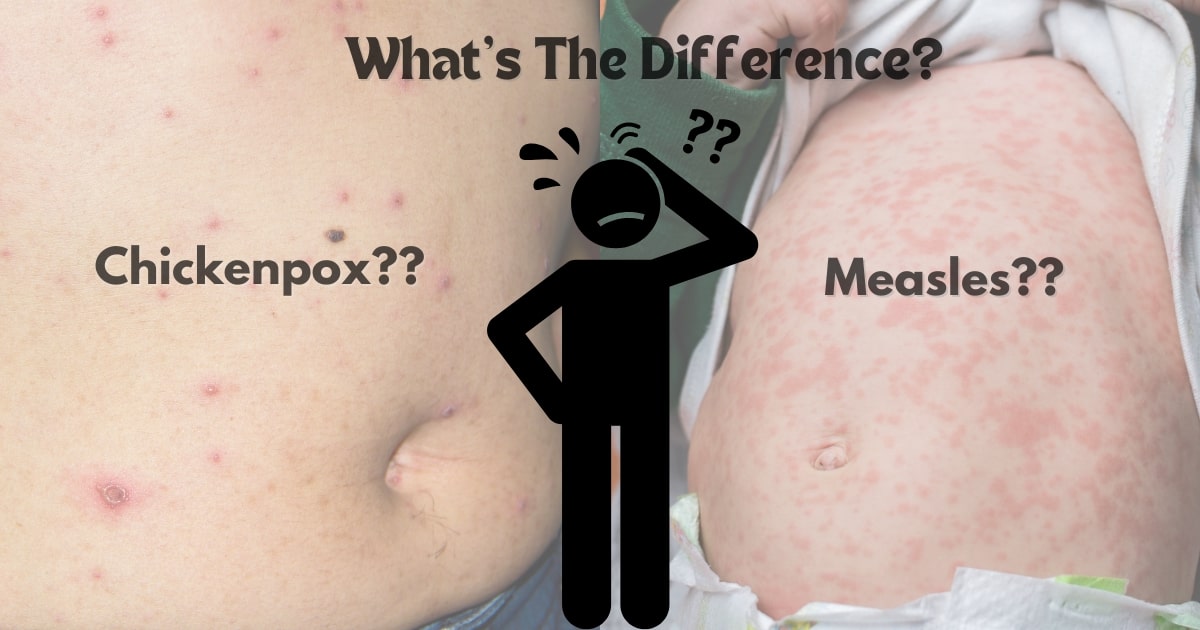 Difference Between Measles and Chickenpox: Symptoms, and treatment