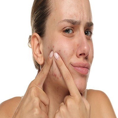 Pimples Treatment in Riyadh for Hormonal Acne Solutions