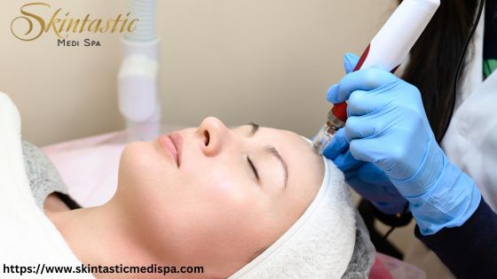 Potenza Microneedling Near Me