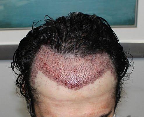 Hair Transplants in Dubai: What Does the Procedure Involve?