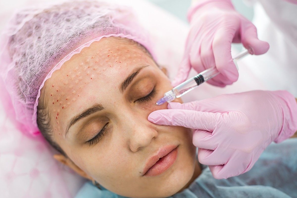 Mesotherapy in Islamabad: A Safe and Effective Way to Rejuvenate Your Skin