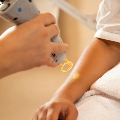 Laser Hair Removal for Facial Hair: Does It Work?