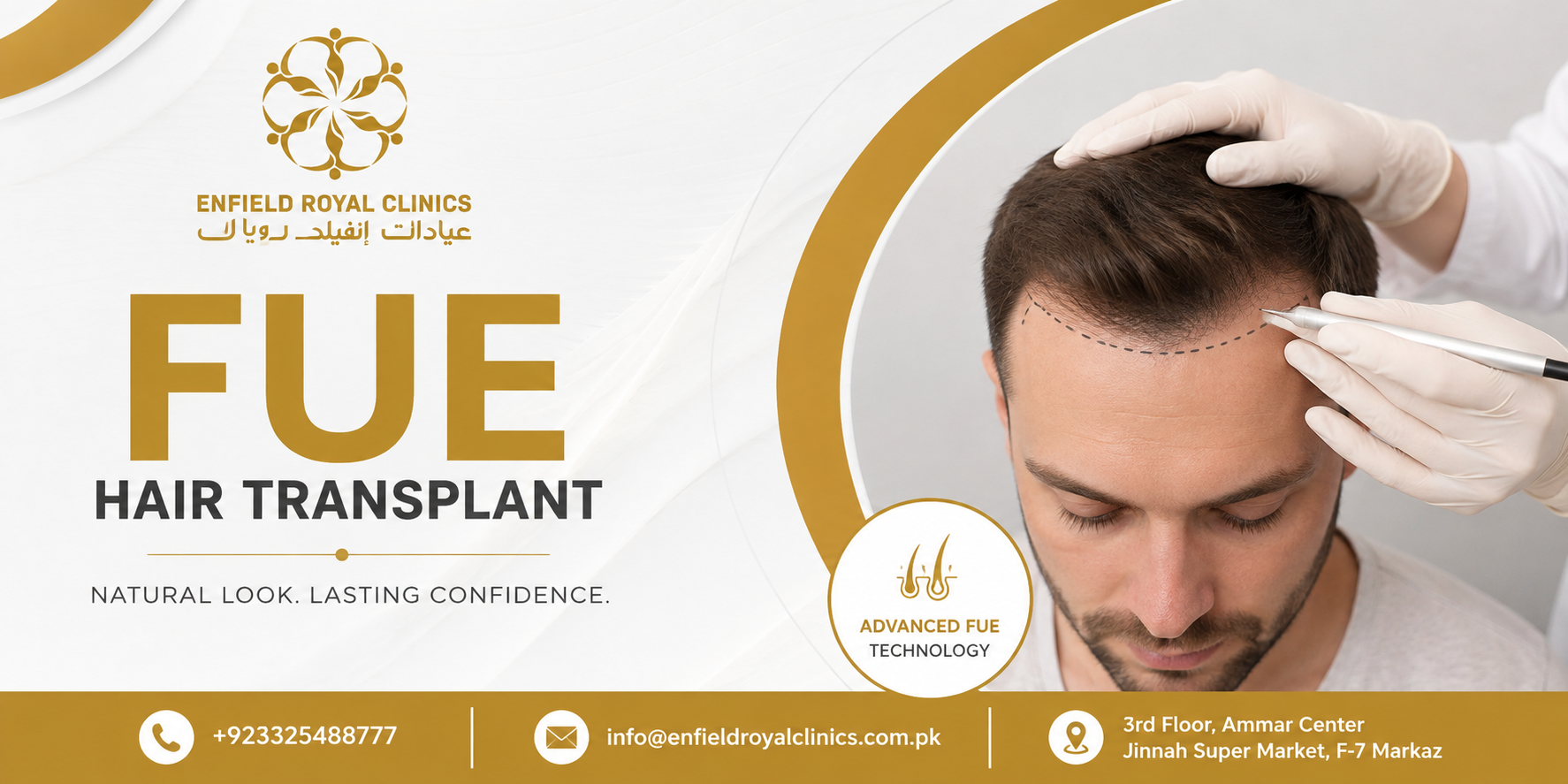 Is FUE Hair Transplant Permanent?
