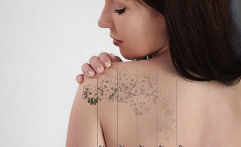 How Effective Is Laser Tattoo Removal for Fading Ink?