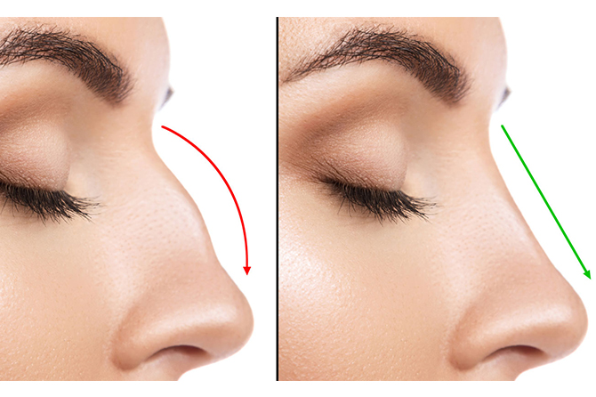 Rhinoplasty in Lahore