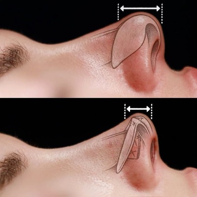 Nose Tip Plasty in Islamabad: Key Factors to Consider Before Nasal Tip Surgery