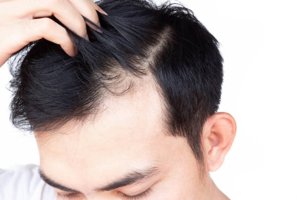 Can G Cell Treatment help with a receding hairline