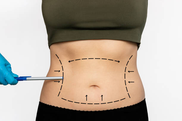 Can Lipo Abdominoplasty improve body proportions