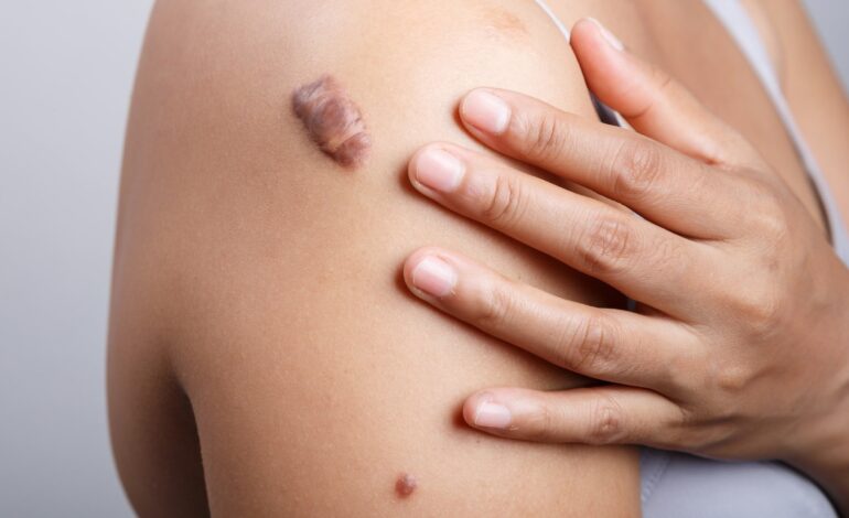 Does Keloid Treatment Improve Scar Appearance
