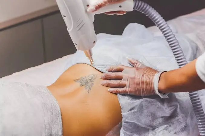 How Can Laser Tattoo Removal Target Stubborn Ink