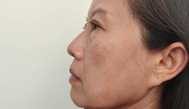 How Does Melasma Treatment Reduce Darkening?