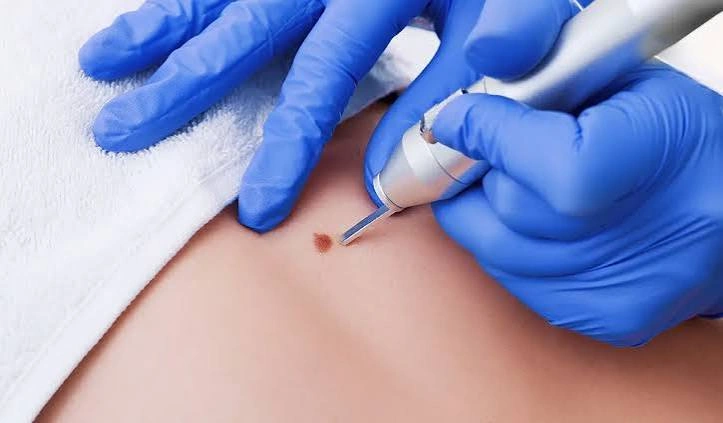 How Does Skin Lesion Removal Improve Skin Clarity