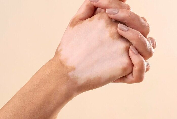 Vitiligo treatment in Abu Dhabi