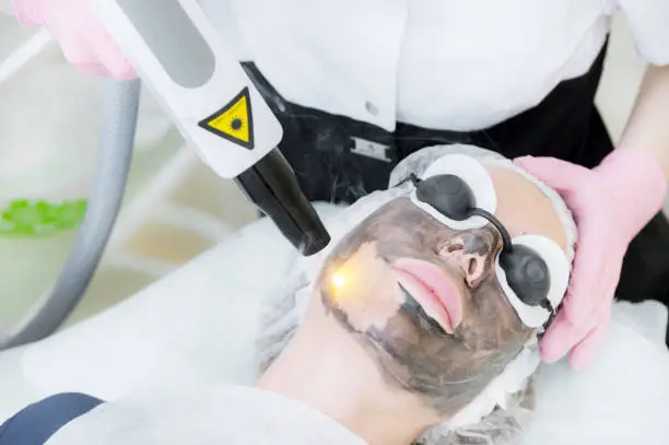 Is Laser Carbon Peel Good for Dull Skin Tone?
