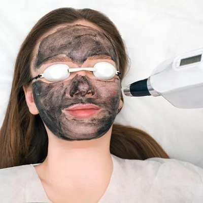 Laser Carbon Peel
