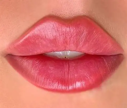 What Makes Russian Lip Fillers Look Natural?