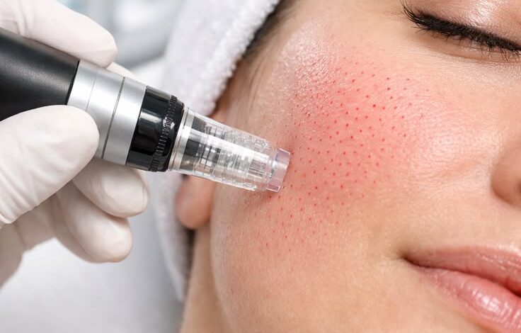 microneedling in islamabad